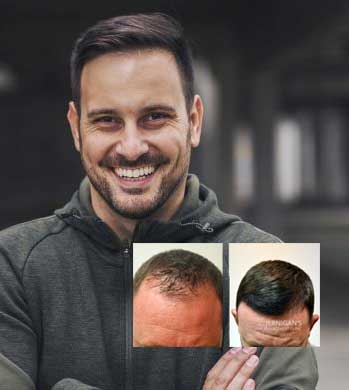 best hair transplants dayton ohio