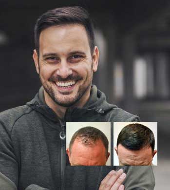 best dayton hair transplant clinic ohio
