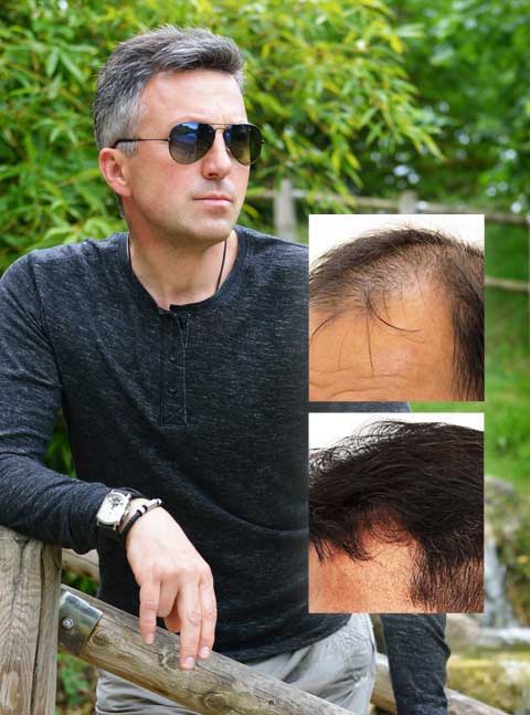 best-hair-transplant-dayton-ohio best hair transplant dayton ohio