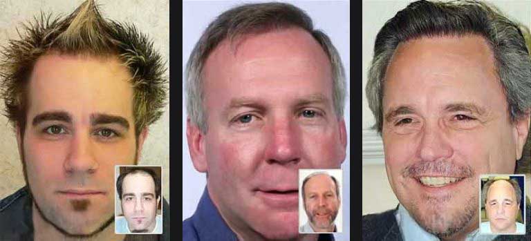 natural-hair-transplant-results-dayton-ohio-clinic hair transplant results dayton ohio