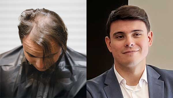 mens-custom-hair-replacement-dayton-ohio